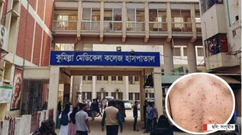 কুমিল্লায় হামের উপসর্গে আরও এক শিশুর মৃ'